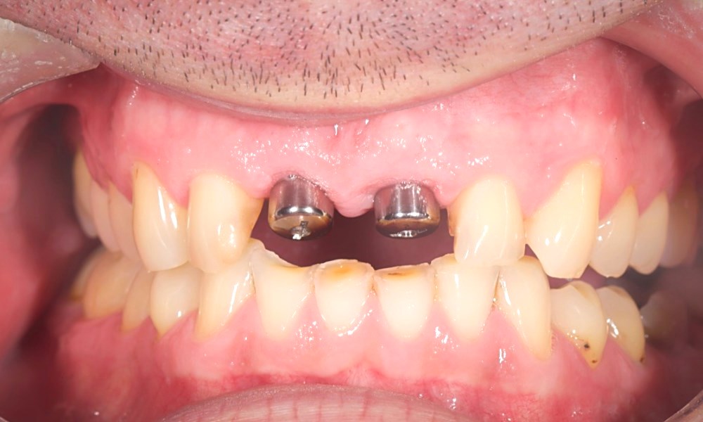 Имплантация двух зубов ДО