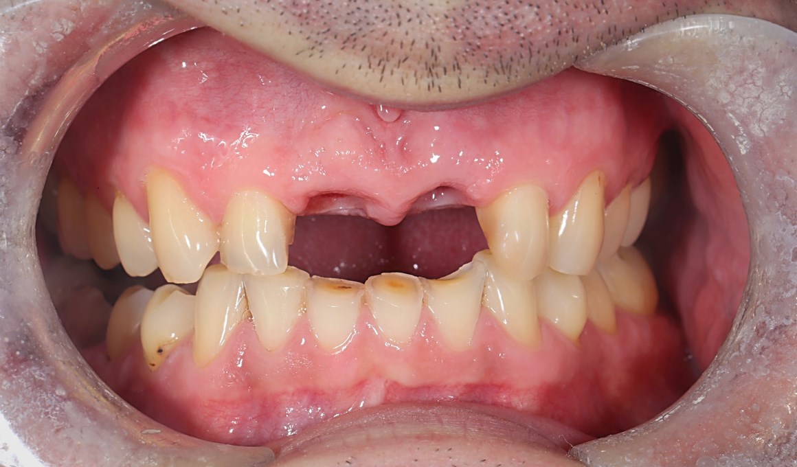 Имплантация передних зубов ДО