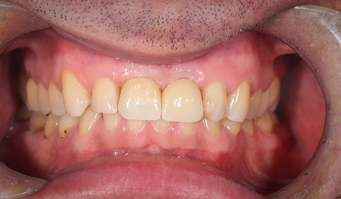 Имплантация передних зубов ПОСЛЕ